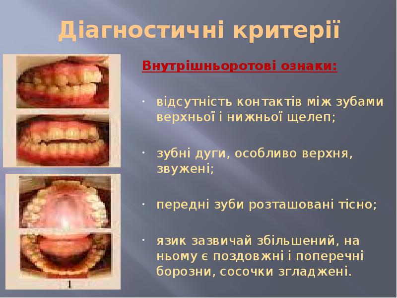 Діагностичні критерії Внутрішньоротові ознаки:  відсутність контактів між зубами верхньої і