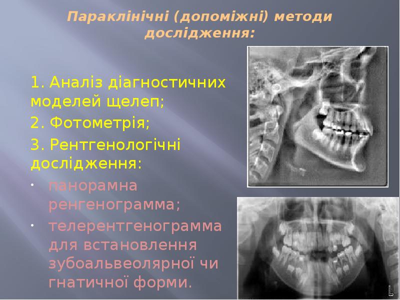 Параклінічні (допоміжні) методи дослідження:  1. Аналіз діагностичних моделей щелеп; 2.