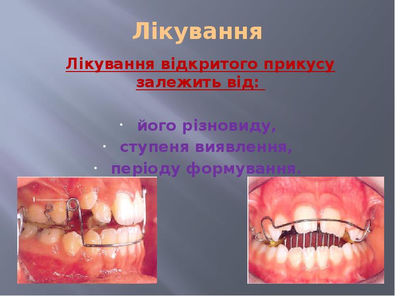 Лікування Лікування відкритогo прикусу залежить від:   йогo різновиду, 