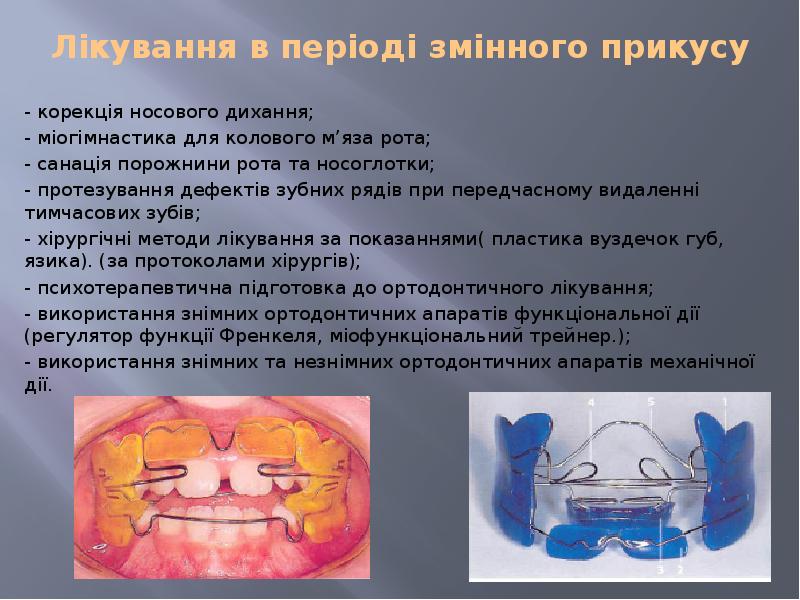 Лікування в періоді змінного прикусу  - корекція носового дихання; -