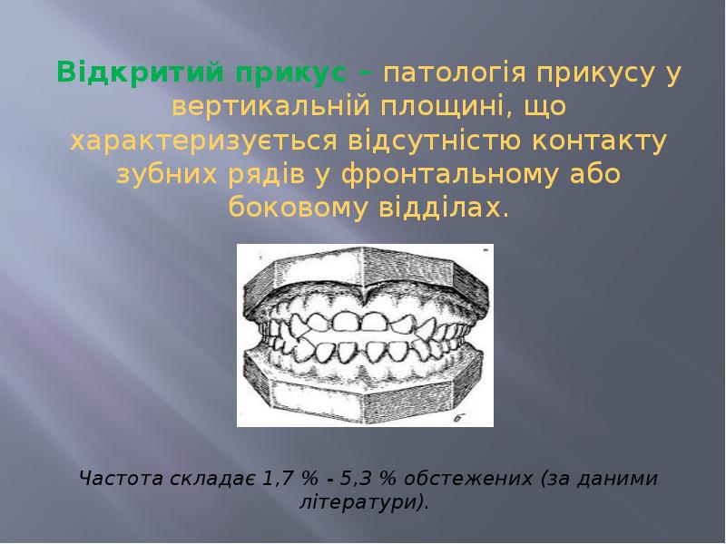 Відкритий прикус – патологія прикусу у вертикальній площині, що характеризується відсутністю