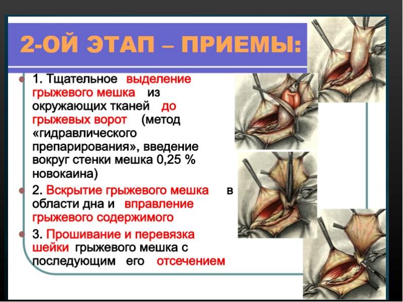 Операции при паховых грыжах презентация thumbnail