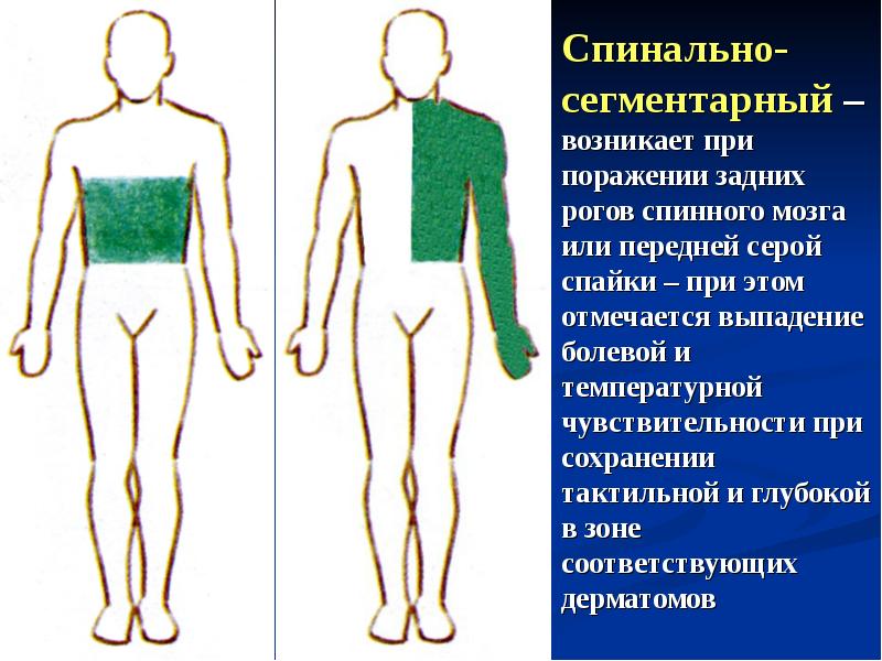 Сегментарный тип расстройства. Нарушение чувствительности. Типы нарушения чувствительности. Корешковый Тип расстройства чувствительности. Сегментарный вид нарушения чувствительности.