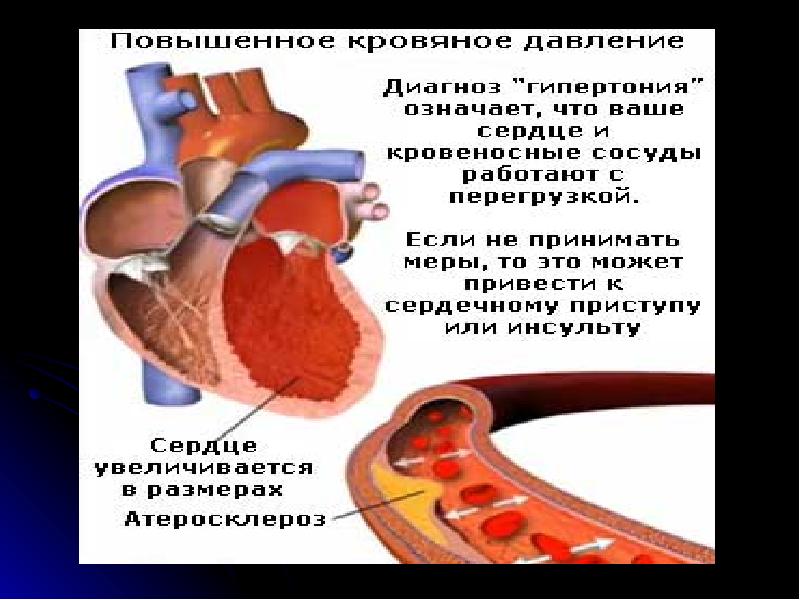 Доклад: Если у вас гипертония