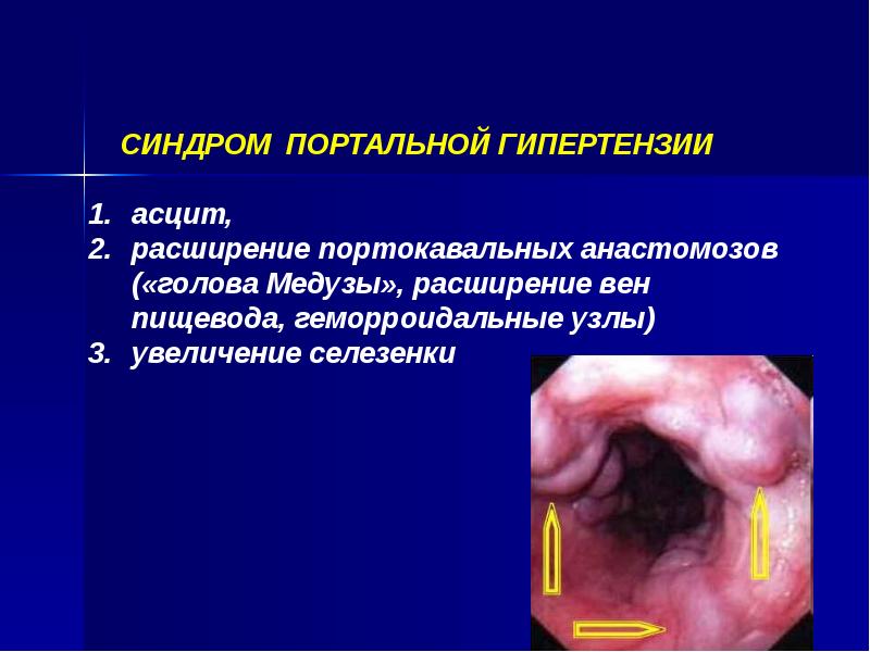 Хронические гепатиты и циррозы печени презентация