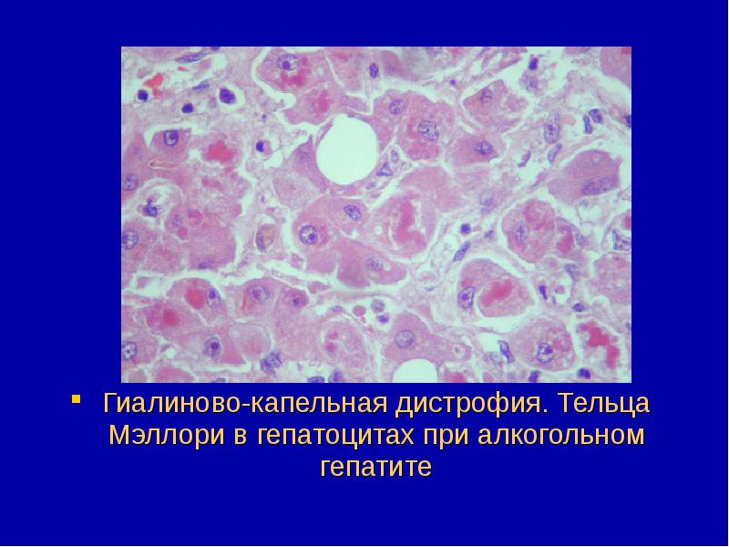 Микроскопическая картина гиалиново капельной дистрофии