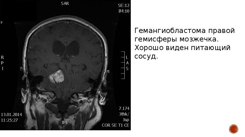 Образование правой гемисферы