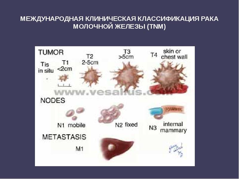 МЕЖДУНАРОДНАЯ КЛИНИЧЕСКАЯ КЛАССИФИКАЦИЯ РАКА МОЛОЧНОЙ ЖЕЛЕЗЫ (TNМ) МЕЖДУНАРОДНАЯ КЛИНИЧЕСКАЯ КЛАССИФИКАЦИЯ РАКА МОЛОЧНОЙ ЖЕЛЕЗЫ (TNМ)