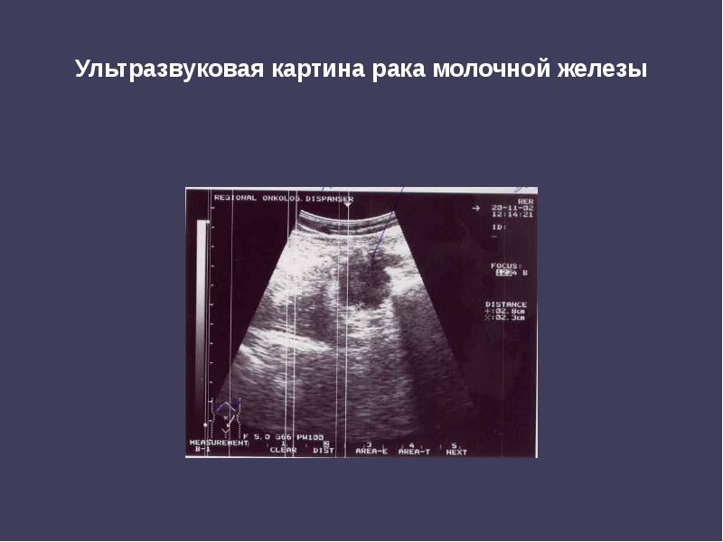 Ультразвуковая картина рака молочной железы Ультразвуковая картина рака молочной железы