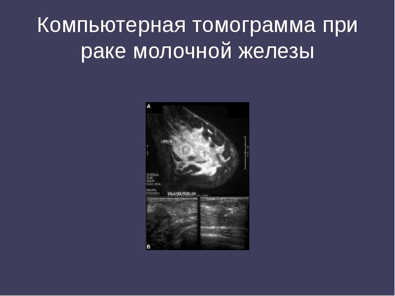 Компьютерная томограмма при раке молочной железы Компьютерная томограмма при раке молочной железы