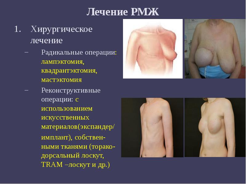 Лечение РМЖ
Хирургическое лечение
Радикальные операции: лампэктомия, квадрантэктомия, мастэктомия
Реконструктивные Лечение РМЖ
Хирургическое лечение
Радикальные операции: лампэктомия, квадрантэктомия, мастэктомия
Реконструктивные