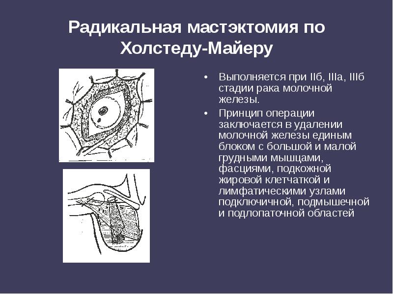 Радикальная мастэктомия по Холстеду-Майеру
Выполняется при IIб, IIIа, IIIб стадии рака Радикальная мастэктомия по Холстеду-Майеру
Выполняется при IIб, IIIа, IIIб стадии рака