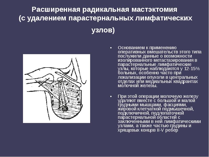 Расширенная радикальная мастэктомия (с удалением парастернальных лимфатических узлов)
Основанием Расширенная радикальная мастэктомия (с удалением парастернальных лимфатических узлов)
Основанием
