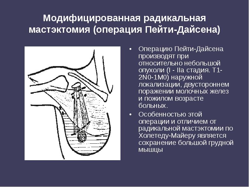 Модифицированная радикальная мастэктомия (операция Пейти-Дайсена)
Операцию Пейти-Дайсена производят при относительно небольшой Модифицированная радикальная мастэктомия (операция Пейти-Дайсена)
Операцию Пейти-Дайсена производят при относительно небольшой