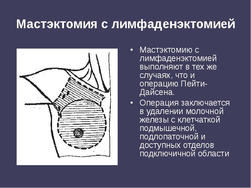 Мастэктомия с лимфаденэктомией
Мастэктомию с лимфаденэктомией выполняют в тех же Мастэктомия с лимфаденэктомией
Мастэктомию с лимфаденэктомией выполняют в тех же