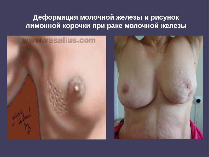 Деформация молочной железы и рисунок лимонной корочки при раке молочной железы Деформация молочной железы и рисунок лимонной корочки при раке молочной железы