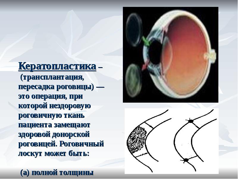 Кератопластика Цена К31