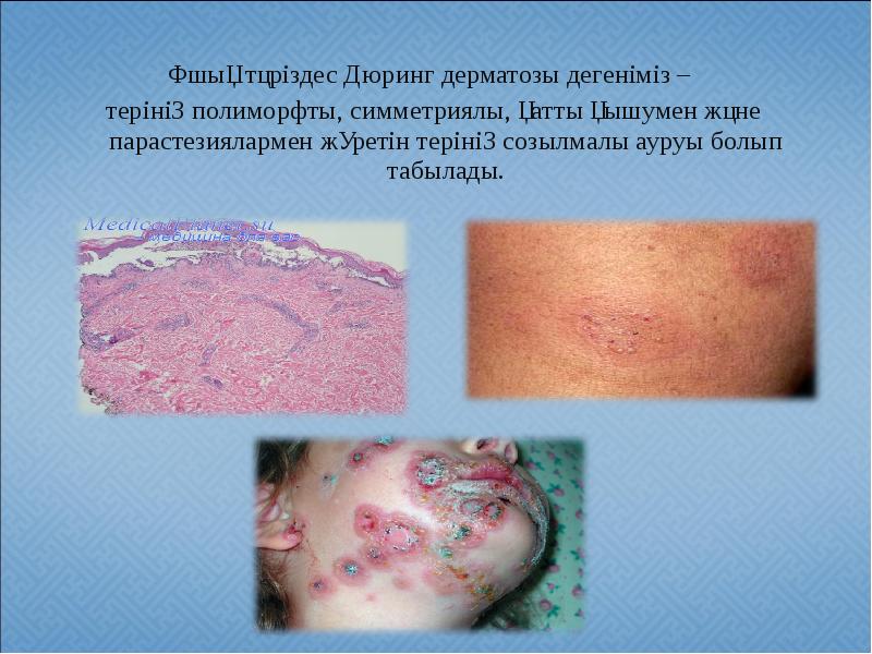 Ұшық тәріздес Дюринг дерматозы дегеніміз –
Ұшық тәріздес Дюринг дерматозы Ұшық тәріздес Дюринг дерматозы дегеніміз –
Ұшық тәріздес Дюринг дерматозы