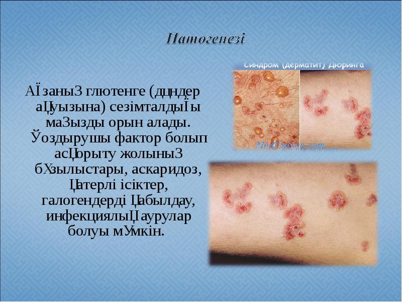 Ағзаның глютенге (дәндер ақуызына) сезімталдығы маңызды орын алады. Қоздырушы фактор болып Ағзаның глютенге (дәндер ақуызына) сезімталдығы маңызды орын алады. Қоздырушы фактор болып