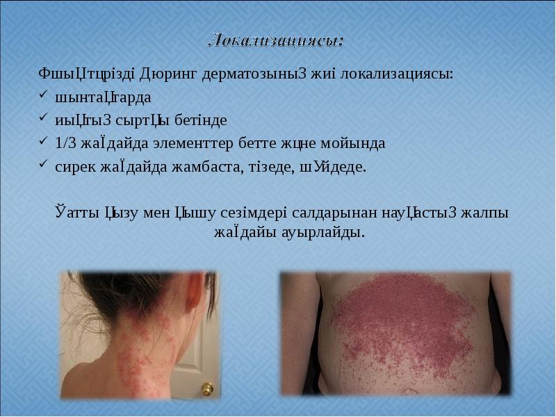 Ұшық тәрізді Дюринг дерматозының жиі локализациясы:
Ұшық тәрізді Дюринг дерматозының Ұшық тәрізді Дюринг дерматозының жиі локализациясы:
Ұшық тәрізді Дюринг дерматозының