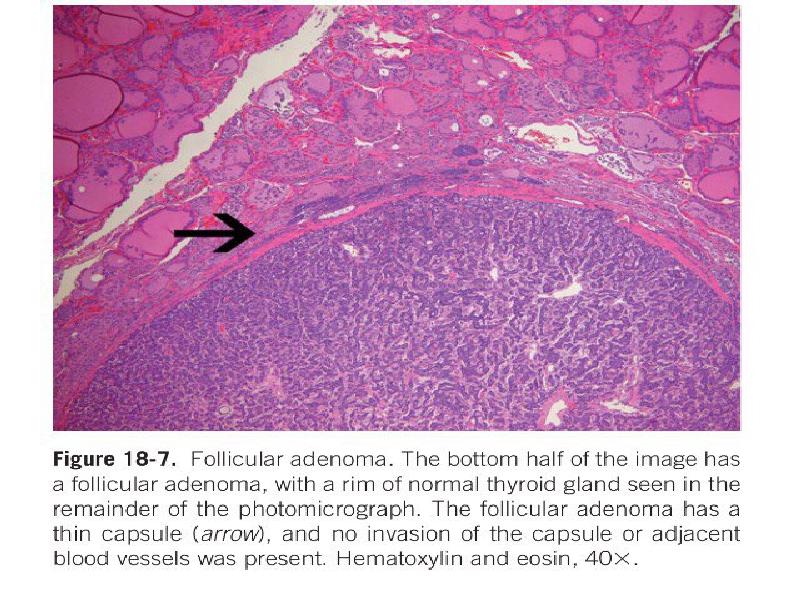 Опухоль железа. Фолликулярная карцинома щитовидной железы гистология. Аденома щитовидной железы микропрепарат. Опухоль щитовидной железы гистология. Фолликулярная аденома щитовидной железы макропрепарат.