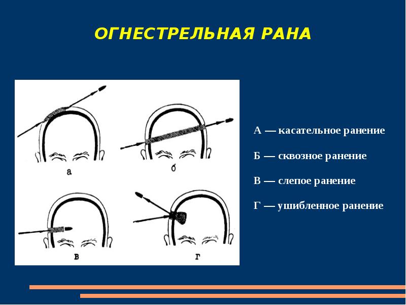 Схема раневого канала