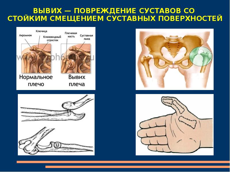 Виды травм в картинках