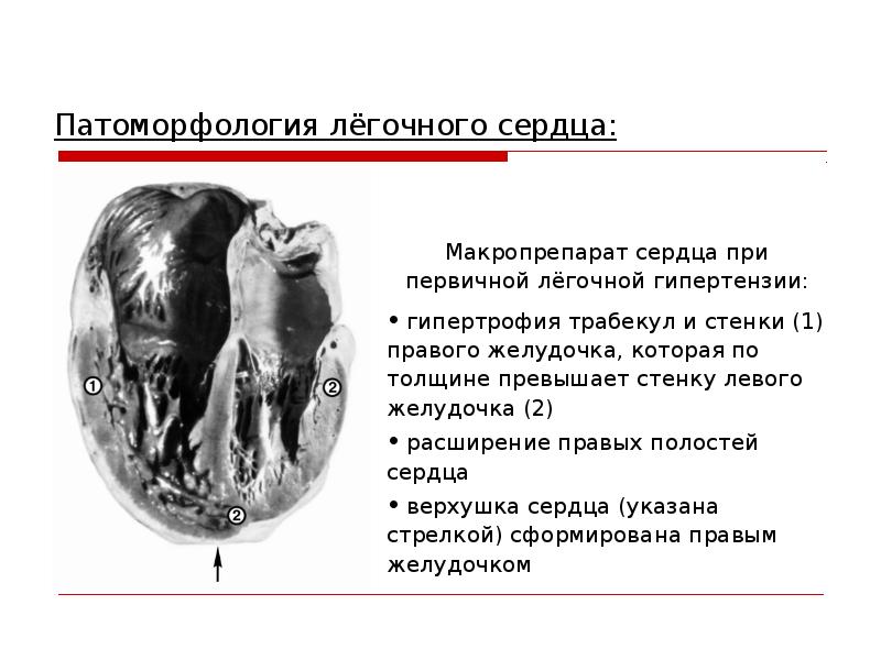 Легочное сердце. Легочное сердце макропрепарат. Отделы сердца, которые гипертрофируются при легочном сердце. Легочное сердце презентация.