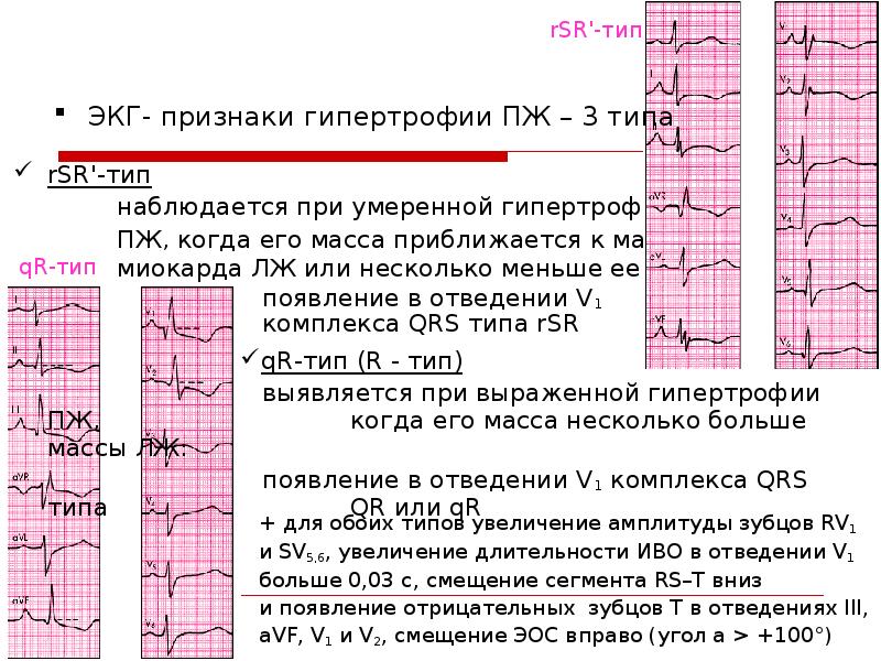 Изменения в миокарде что это значит