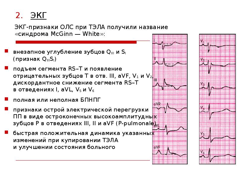 Что означает экг. Отрицательный зубец т на ЭКГ В отведениях v1-3. Отрицательный т в v1 отведении зубец на ЭКГ. Отрицательный зубец т на ЭКГ В 1 И 2 отведениях. Отрицательный зубец т на ЭКГ В 1 отведении.