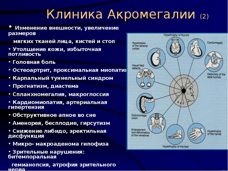 Акромегалия клиническая картина