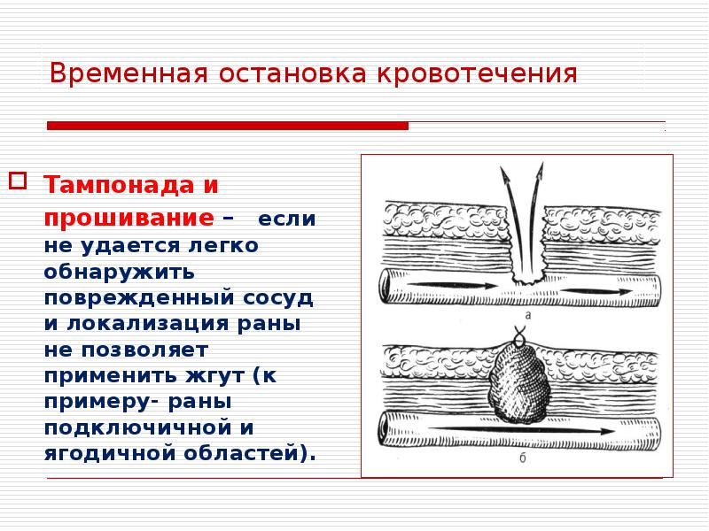 Тампонада раны при кровотечении. Тампонада по Микуличу схема. Остановка кровотечения тампонада. Тампонада раны алгоритм.