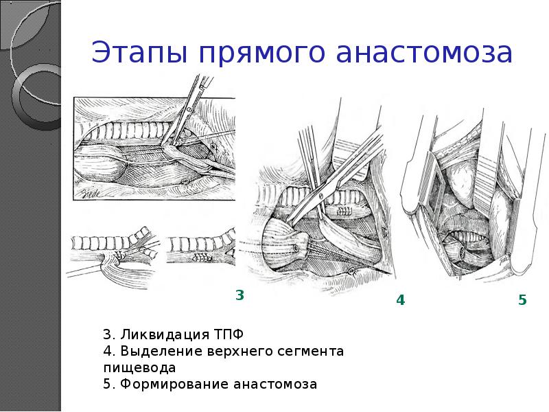 Реферат: Атрезия пищевода