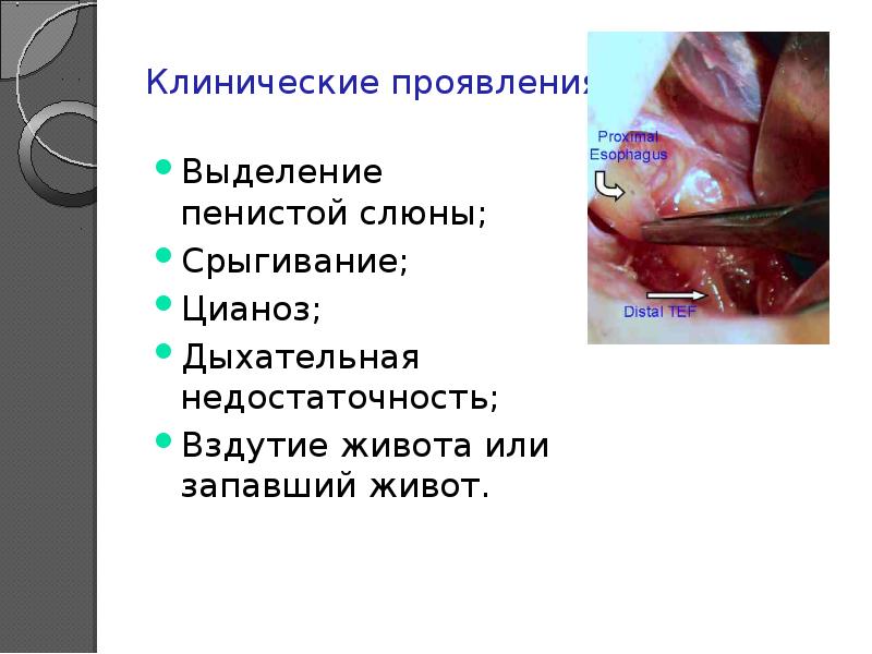 Реферат: Атрезия пищевода