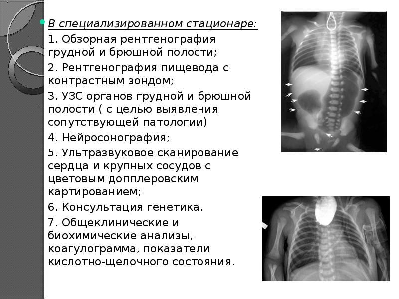 Реферат: Атрезия пищевода