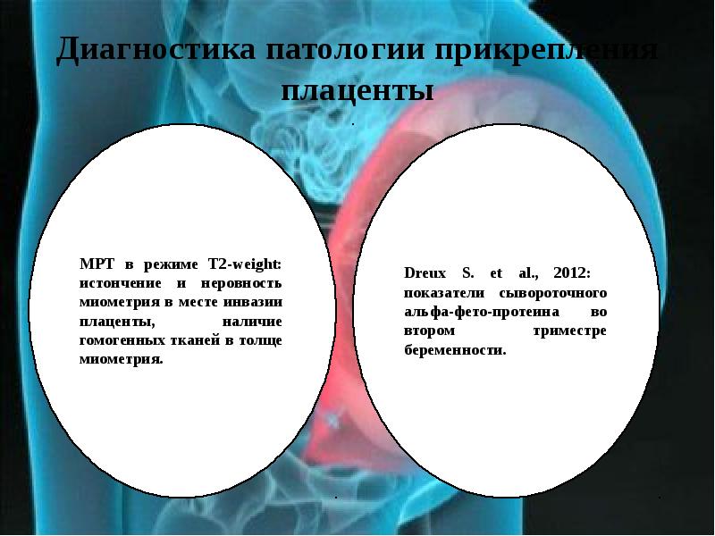 Врастание плаценты презентация