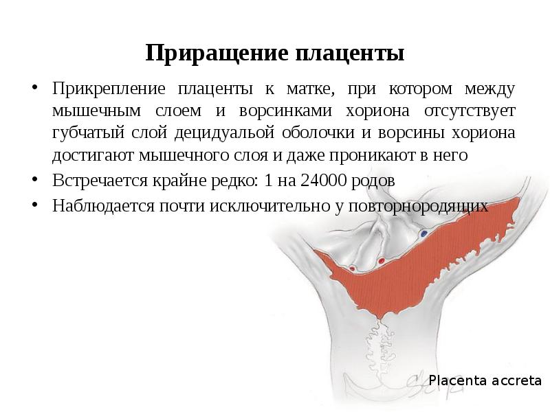 Случай благополучного завершения беременности при врастании плаценты