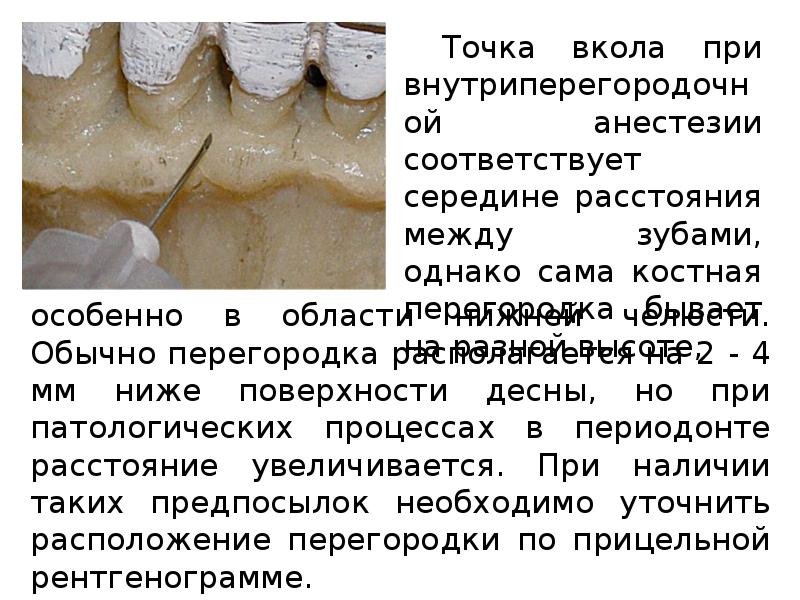 Обезболивающее после лечения зуба