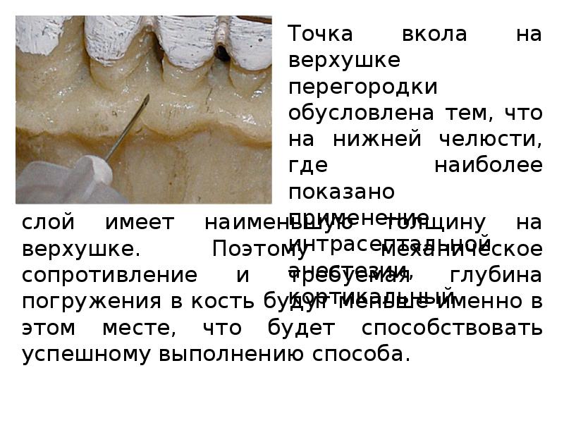 Методы обезболивания при лечении зубов презентации