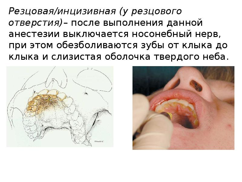 Методы обезболивания при лечении зубов презентации