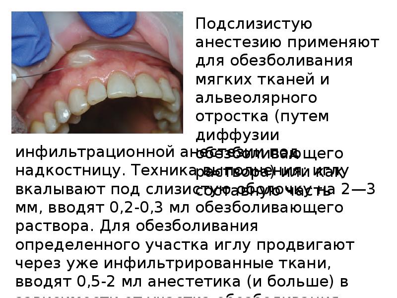 Методы обезболивания при лечении зубов презентации