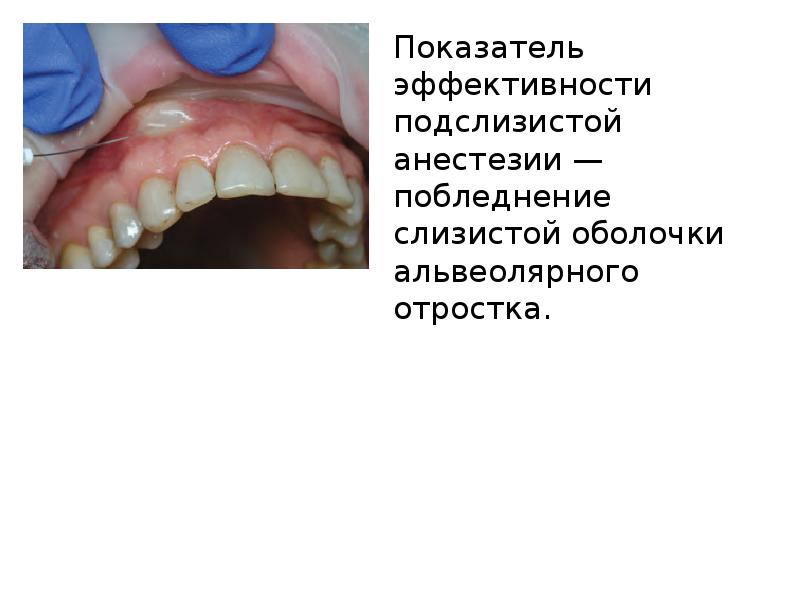 Методы обезболивания при лечении зубов презентации