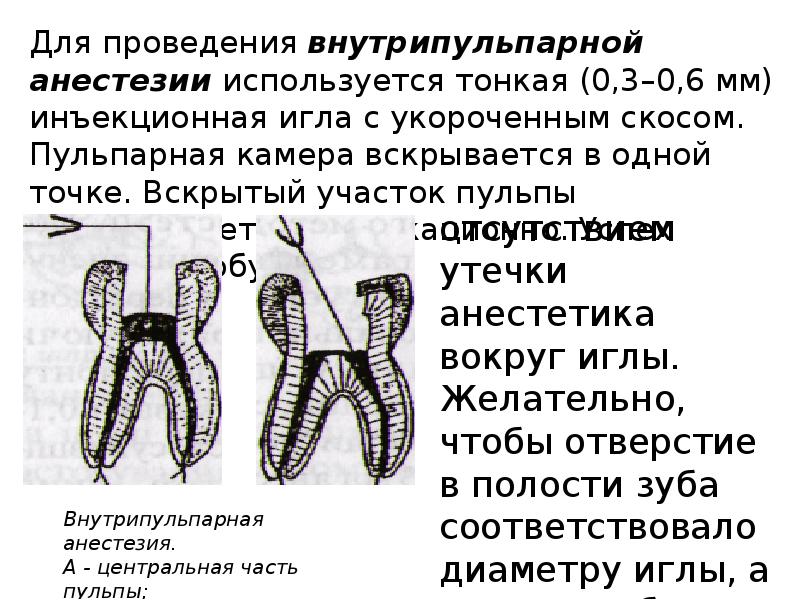 Методы обезболивания при лечении зубов презентации