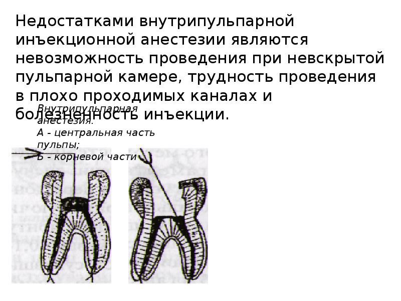 Методы обезболивания при лечении зубов презентации