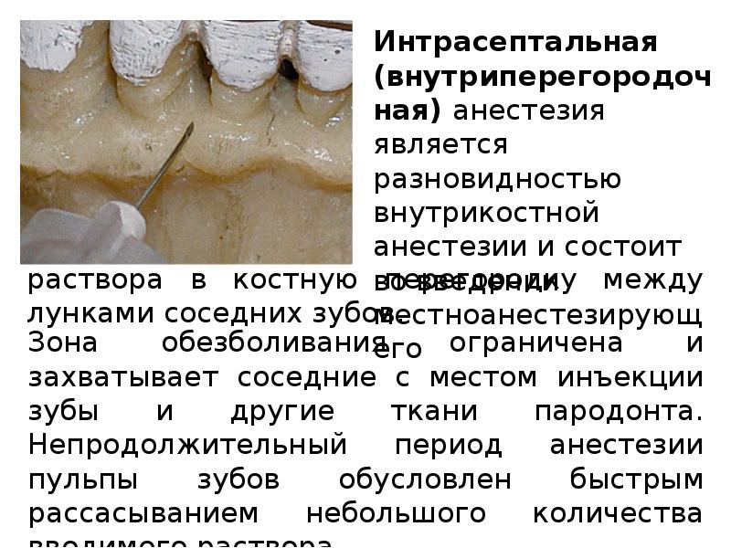 Лечат ли зубы с анестезией