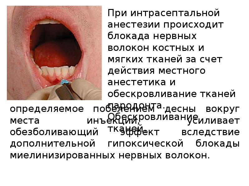 Методы обезболивания при лечении зубов презентации