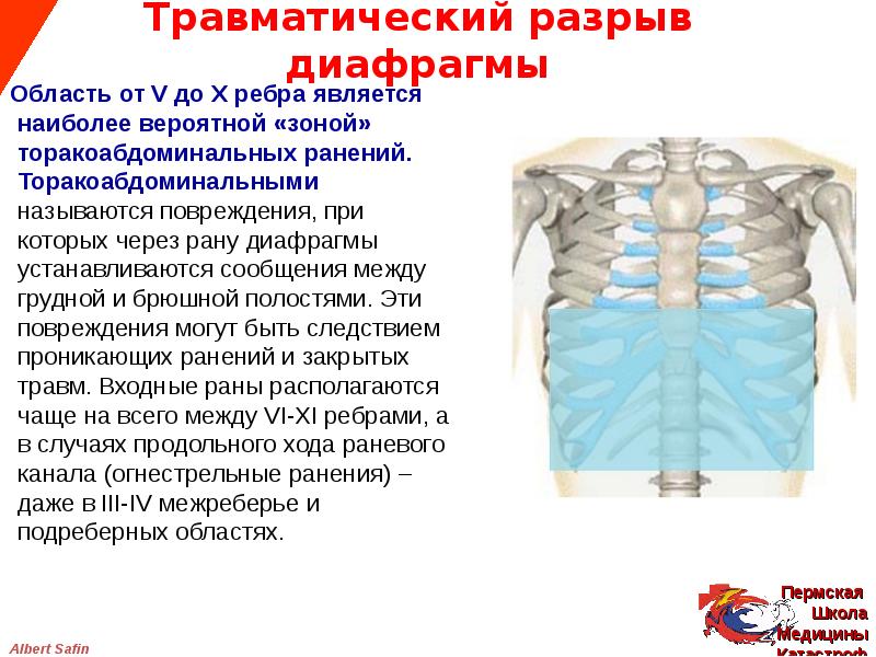 Болит диафрагма. Травматический разрыв диафрагмы. Разрыв диафрагмы классификация.