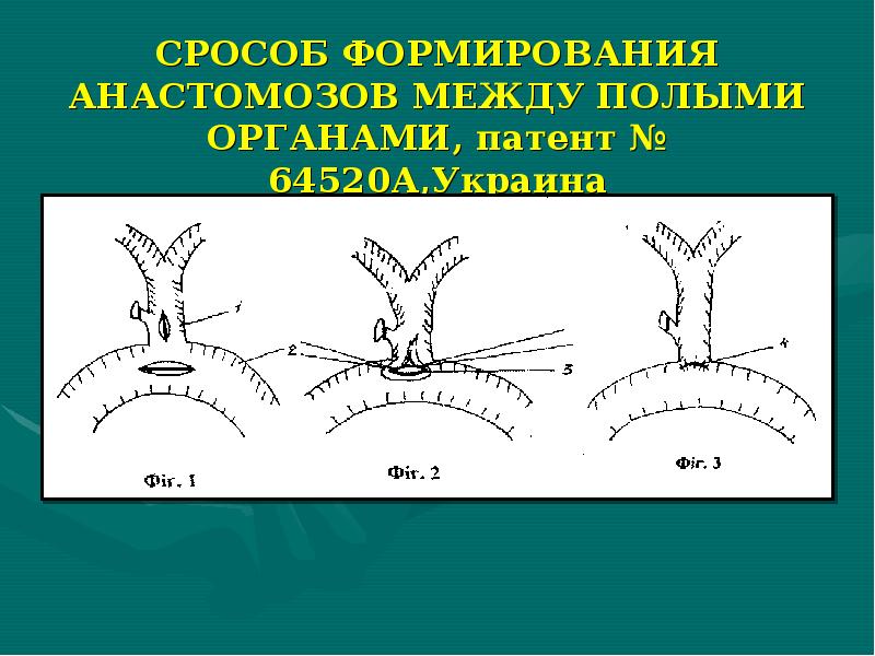 Желчекаменная болезнь презентация