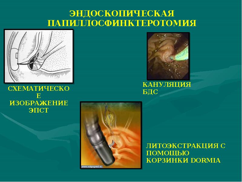 Желчекаменная болезнь презентация