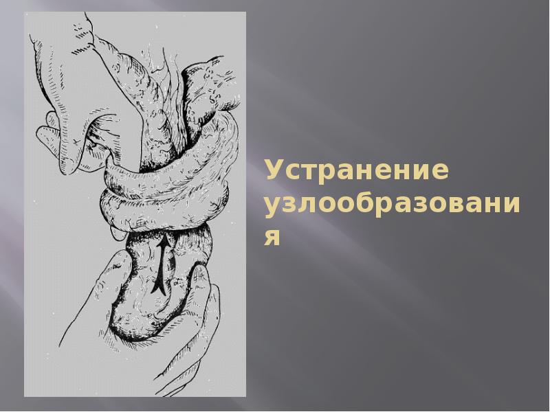 Острая кишечная непроходимость госпитальная хирургия презентация